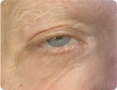 Ptose Palpebral