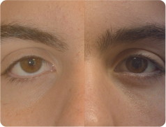 Retração Palpebral