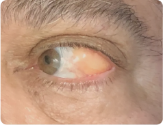 Hérnia subconjuntival