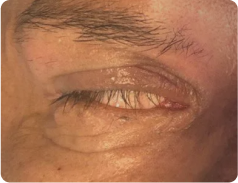 Lagoftalmo paralítico