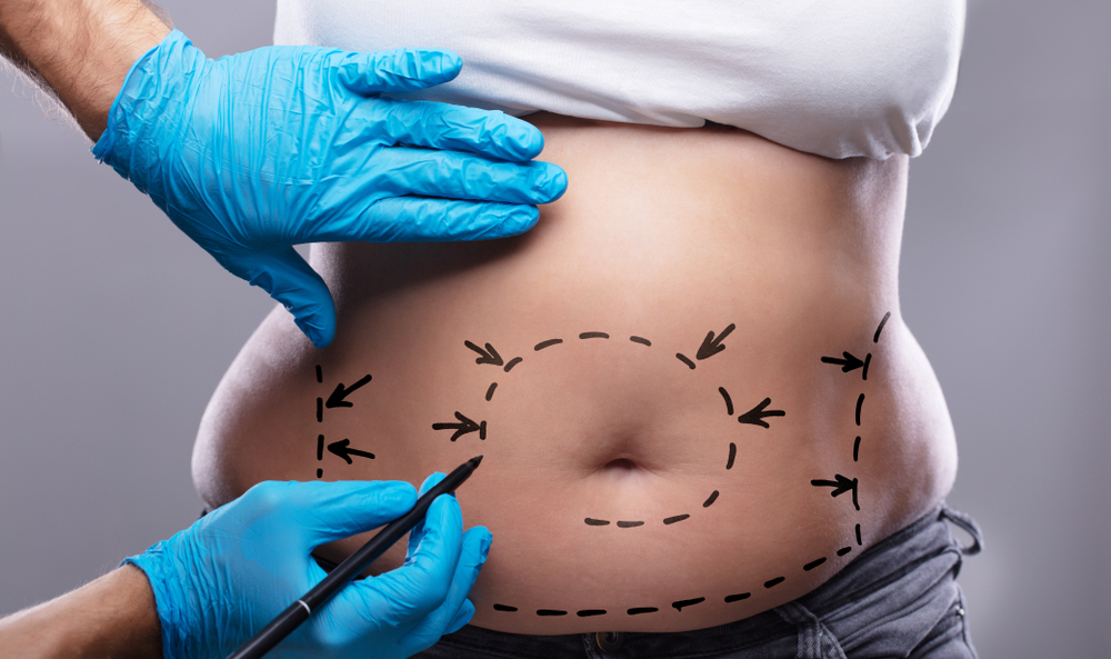 Abdominoplastia: indicação e como é feita