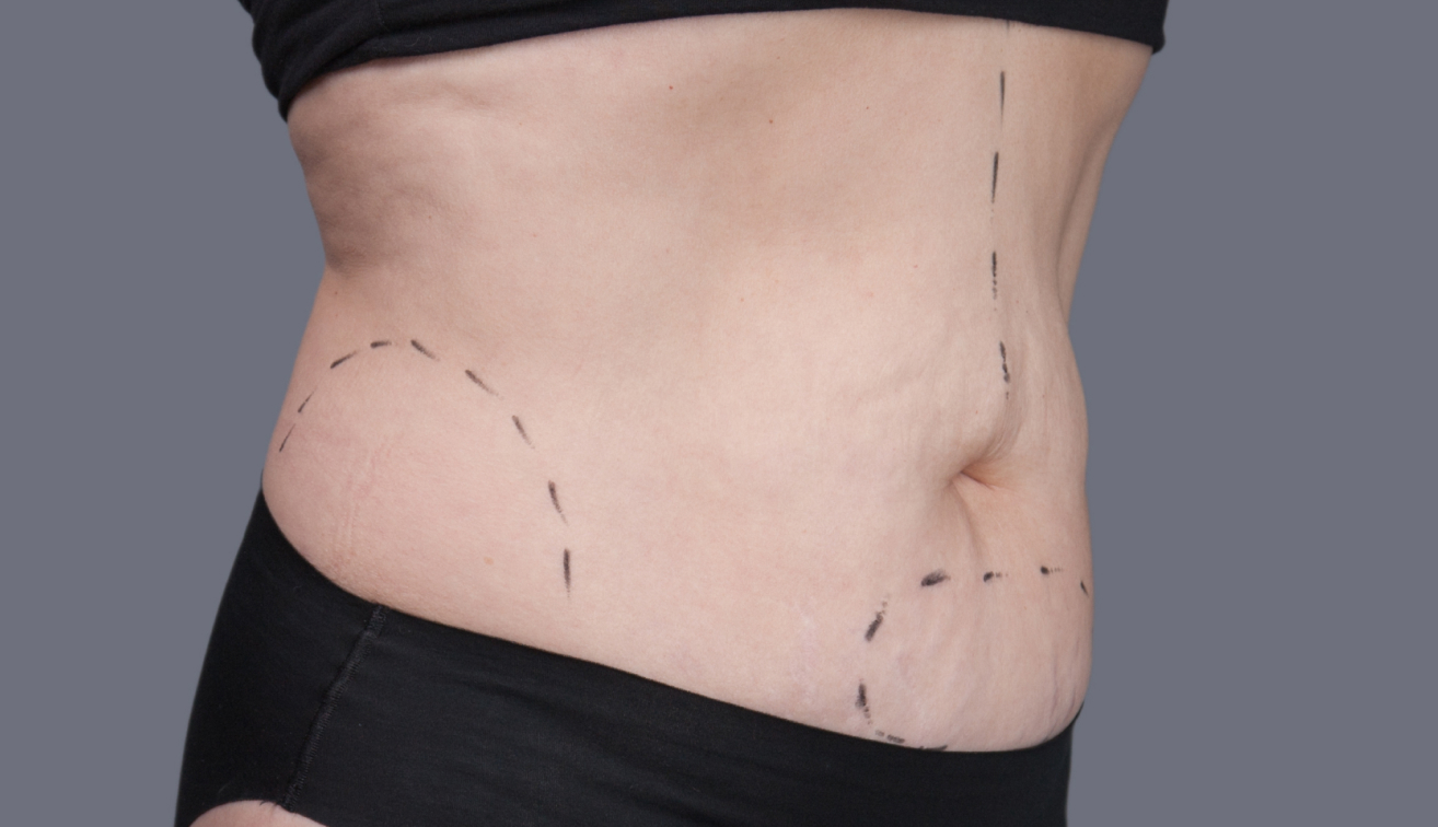 Abdominoplastia: indicação e como é feita