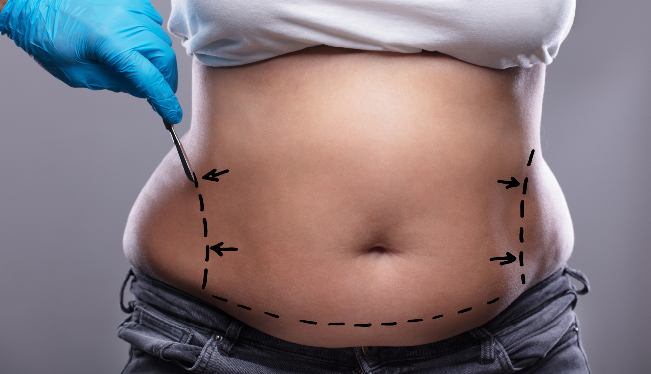 Abdominoplastia: indicação e como é feita