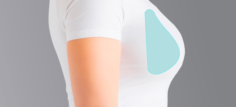 Mamoplastia de aumento: como é realizada?