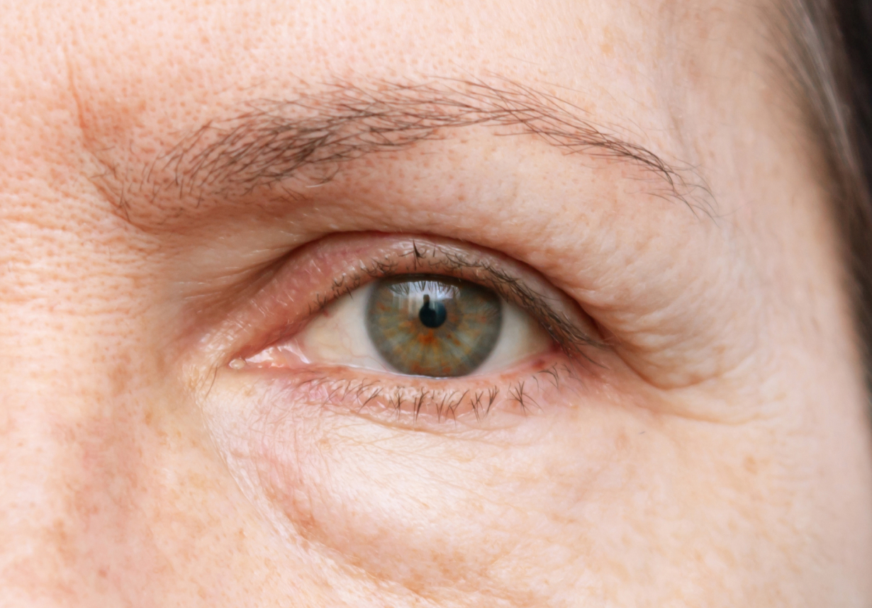 Blefaroplastia: como funciona a cirurgia de pálpebras?