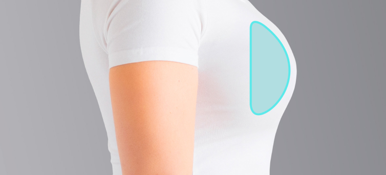 Mamoplastia de aumento: como é realizada?