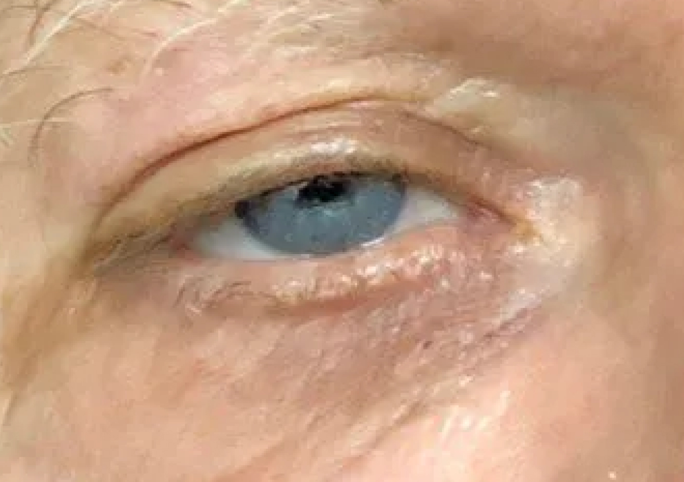 Ptose palpebral: causas, sintomas e tratamento