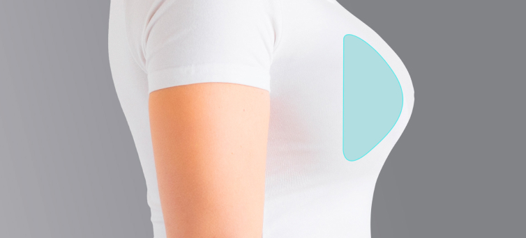 Mamoplastia de aumento: como é realizada?
