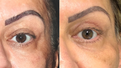 Blefaroplastia: como funciona a cirurgia de pálpebras?