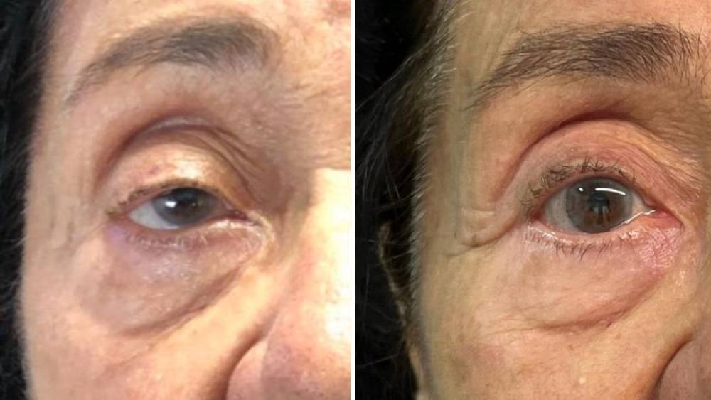 Ptose palpebral: causas, sintomas e tratamento