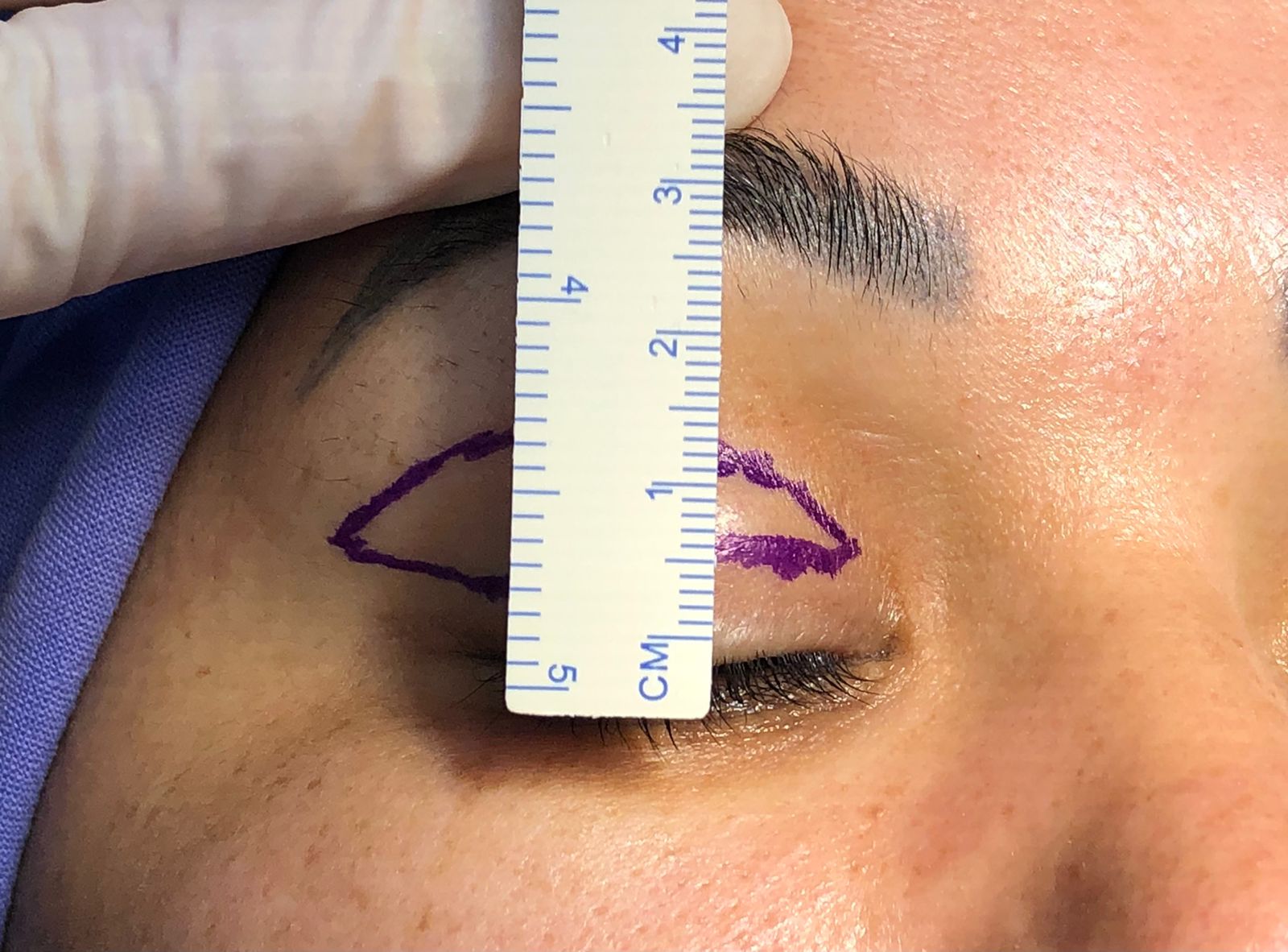 Blefaroplastia: como funciona a cirurgia de pálpebras?